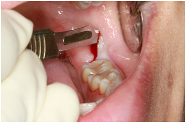 Surgical Tooth Removal Abu Dhabi