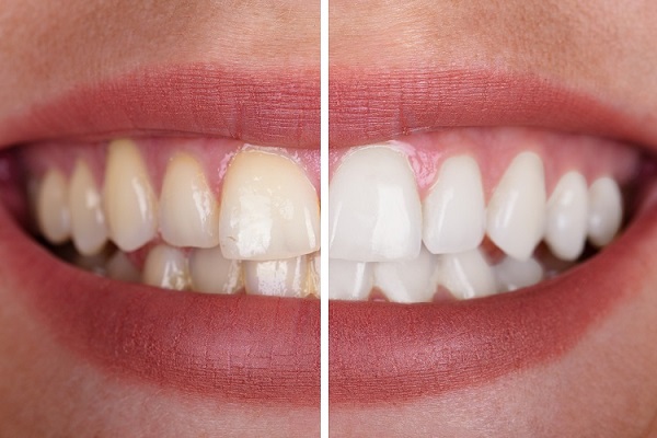 Teeth Whitening Abu Dhabi