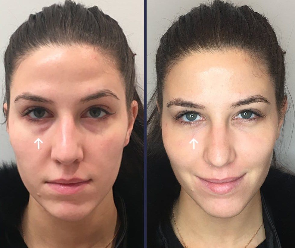 Under Eye Fillers - Abu Dhabi