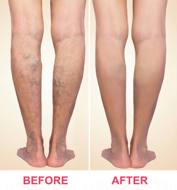 Varicose Veins Treatment Abu Dhabi